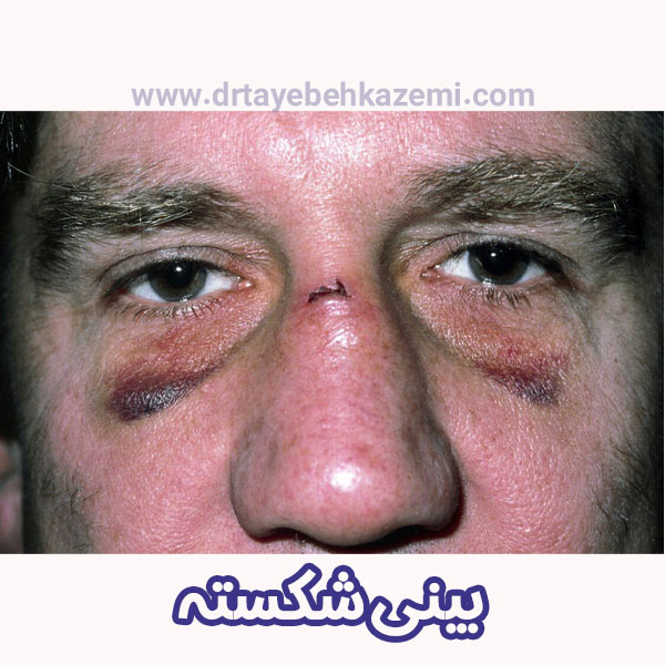 عکس دماغ شکسته