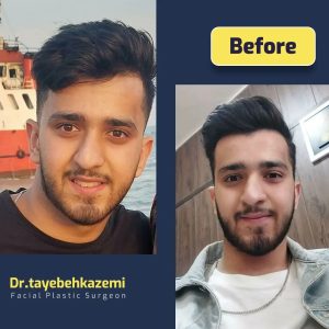 جراحی بینی - https://drtayebehkazemi.com/