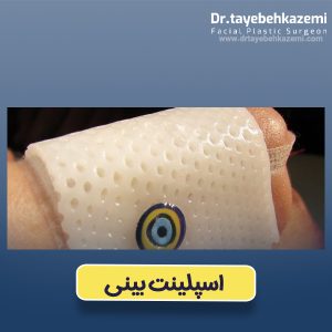 اسپلینت بینی - https://drtayebehkazemi.com/