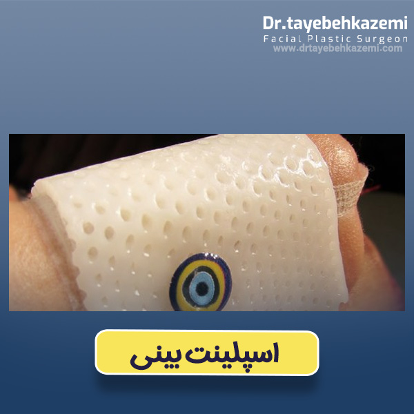 اسپلینت بینی - https://drtayebehkazemi.com/