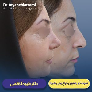 نمونه کار بهترین جراح بینی شیراز - https://drtayebehkazemi.com/