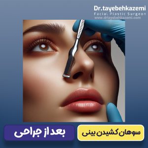 سوهان کشیدن بینی بعد از جراحی - https://drtayebehkazemi.com/