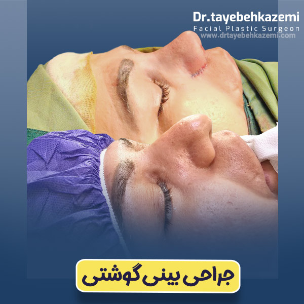 جراحی بینی گوشتی - https://drtayebehkazemi.com/