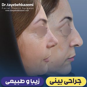 عکس نمونه کار واقعی جراحی بینی توسط دکتر طیبه کاظمی