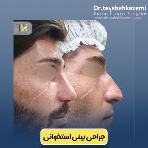 جراحی بینی استخوانی