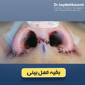 بخیه عمل بینی - https://drtayebehkazemi.com/