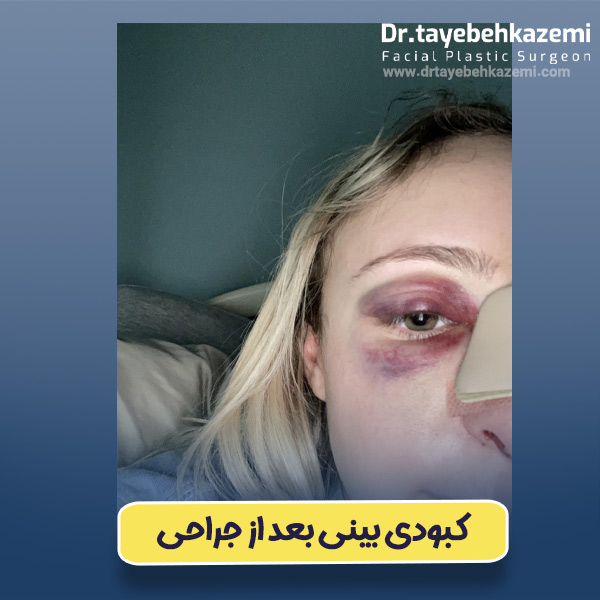 کبودی بینی بعد از جراحی - https://drtayebehkazemi.com/