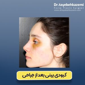 کبودی بینی بعد از جراحی - https://drtayebehkazemi.com/