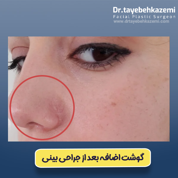 گوشت اضافه بعد از جراحی بینی - https://drtayebehkazemi.com/