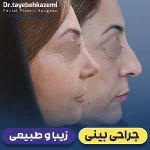 عکس نمونه کار جراحی بینی طبیعی