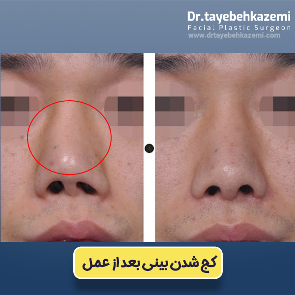 عکس کج شدن بینی بعد از جراحی