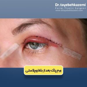 ورم پلک بعد از بلفاروپلاستی