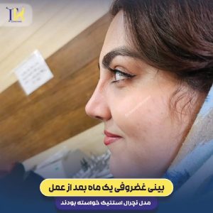 عکس نمونه کار بهترین جراح بینی شیراز