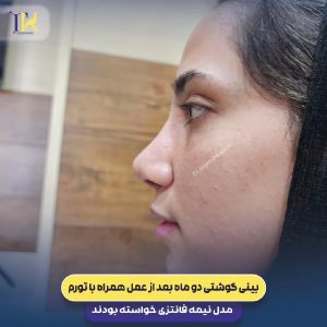 عکس نمونه کار دکتر عمل بینی در شیراز