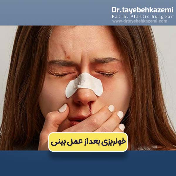 خونریزی بعد از عمل بینی