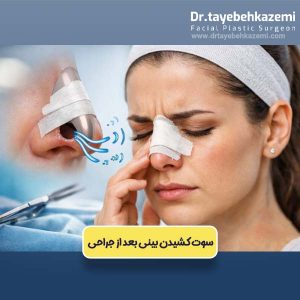 سوت کشیدن بینی بعد از جراحی